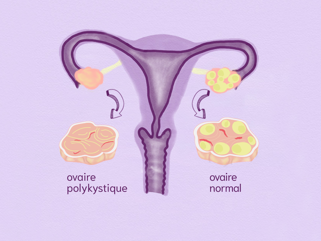 Syndrome des ovaires polykystiques schéma