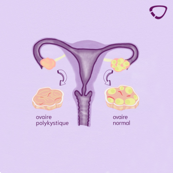 Syndrome des ovaires polykystiques schéma