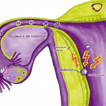 douleurs de nidation