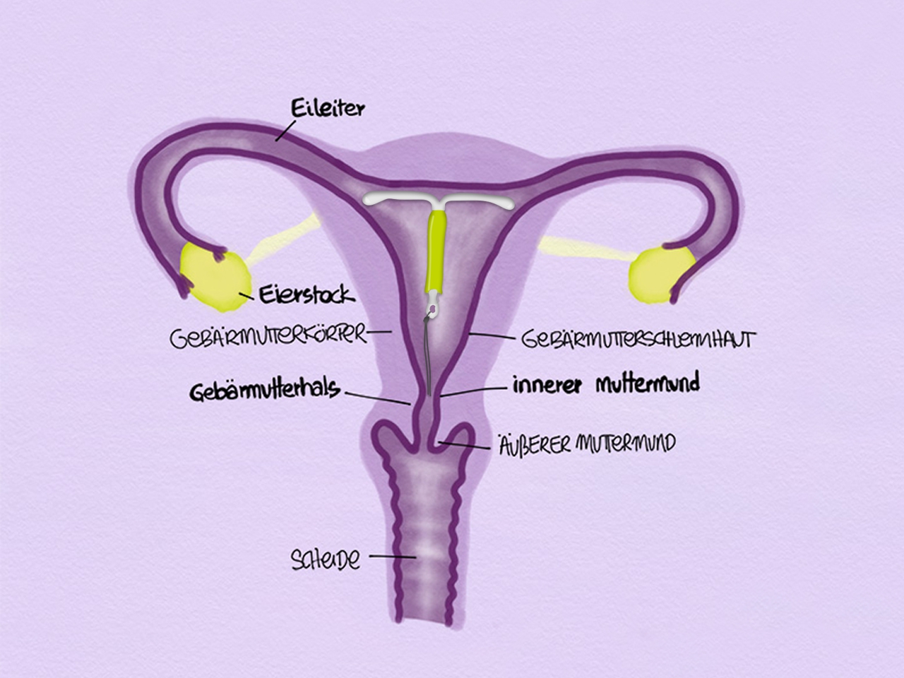 Comment fonctionne le stérilet hormonal (DIU) ? | cyclotest