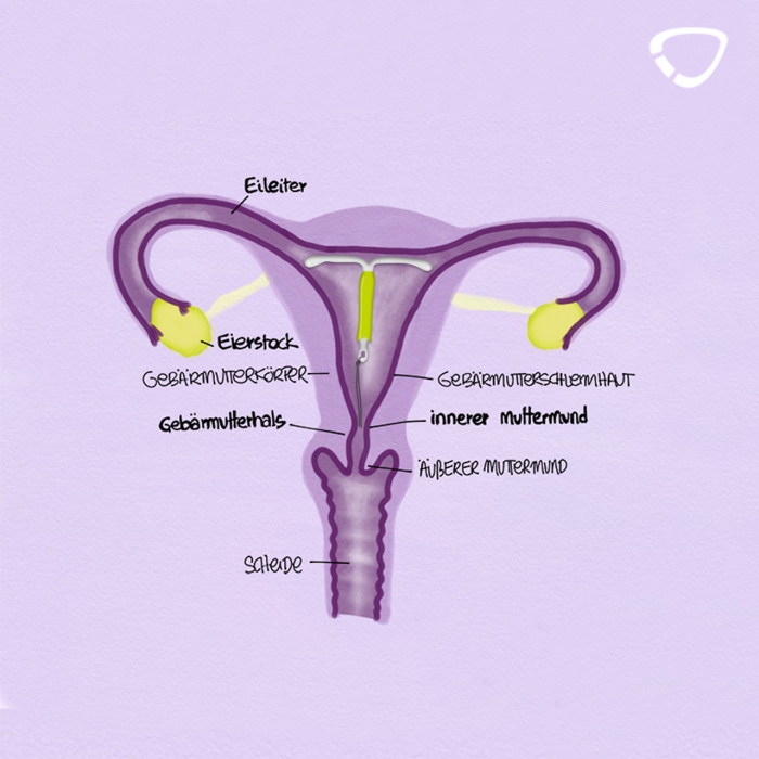 Le stérilet au cuivre (DIU) la contraception idéale ? cyclotest