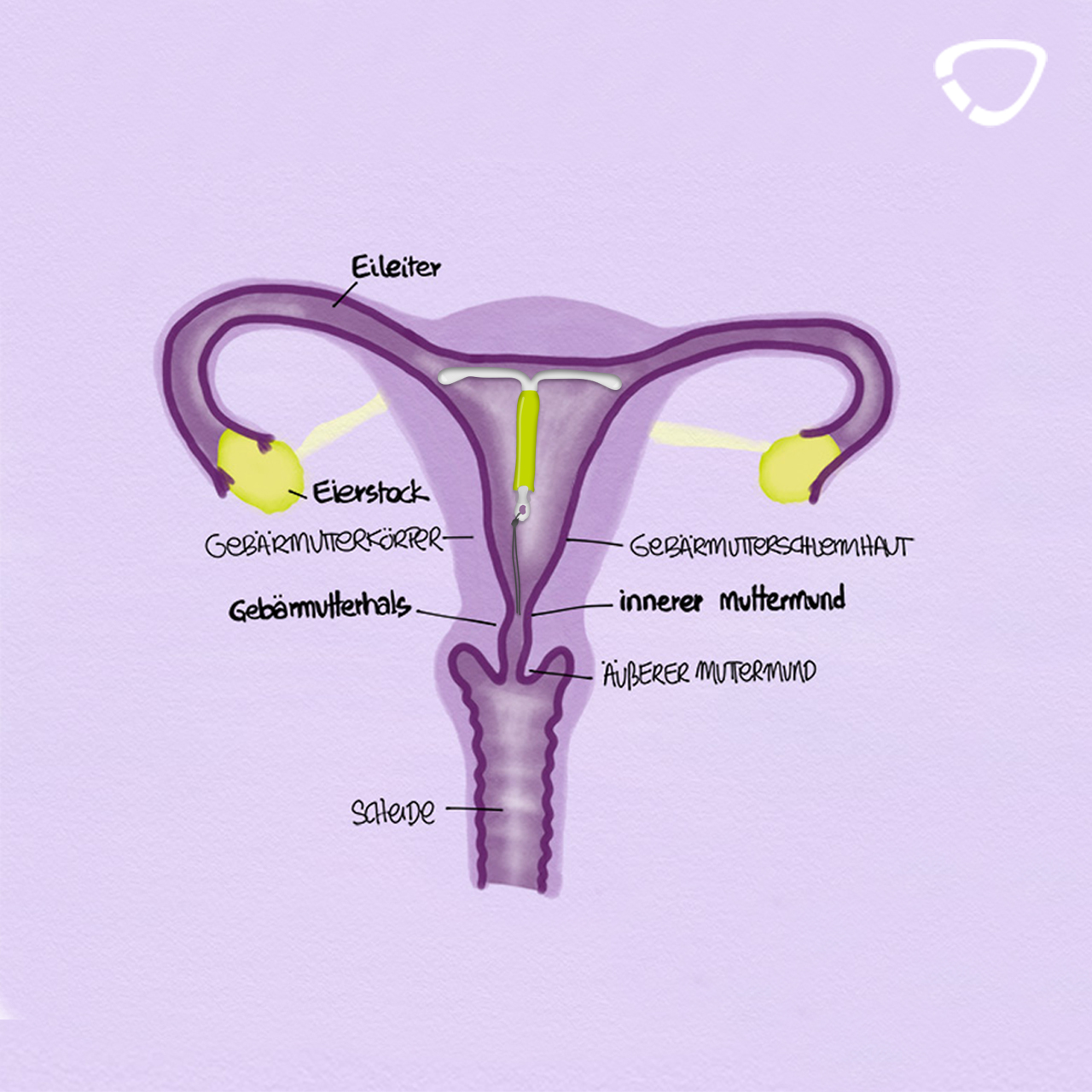 Comment fonctionne le stérilet hormonal (DIU) ? | cyclotest